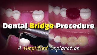 Dental Bridge Procedure [upl. by Waldner620]