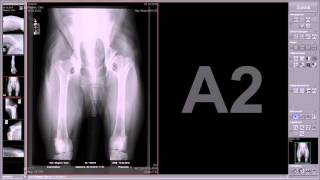 RADIOGRAFER TEKNIK PEMERIKSAAN CT SCAN ABDOMEN TANPA KONTRAS PROSEDUR REGISTER HINGGA CETAK FILM [upl. by Yerag858]