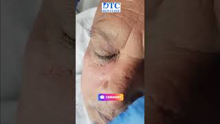 Watch Our Skin Tag Removal Procedure at DTC Skin Clinic [upl. by Kitti]