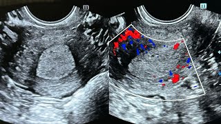 Thickened endometrium  Drpruthvirajmo [upl. by Hudgens]