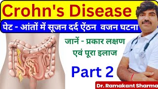 Crohns Disease A Comprehensive Guide to Diagnosis and Managementdrramakantsharma7 [upl. by Abdul]