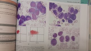 Acute Myeloid Leukemia  SPECIAL PATHOLOGY [upl. by Alliuqet822]