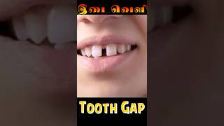 முன் பற்கள் இடைவெளி சரி செய்வது எப்படி  Teeth gap closure option [upl. by Jehiah]