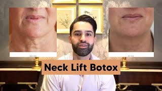 Neck Lift Botox [upl. by Crissy]