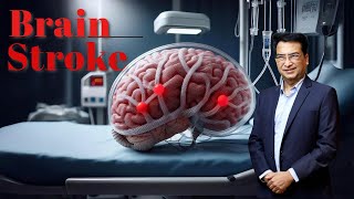 Understanding Brain Strokes Effects Symptoms amp Treatment  Expert Insights with Dr Praveen Gupta [upl. by Cioffred221]