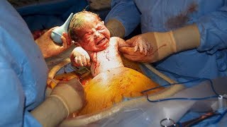 Csection Cesarean Delivery [upl. by Airolg]