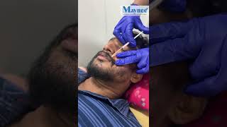 Actor Sathya  Beard Growth Journey  Beard Transplantation and PRP  Maynee Cosmetology Clinic [upl. by Bosch]