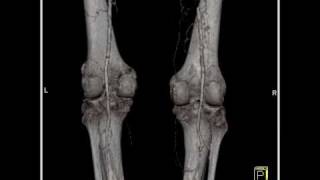 Vascular CT angiography defines evidence of a stenosis in the SFA 2 of 2 [upl. by Alhahs888]