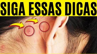 Espinhas Atrás da Orelha  As Melhores DICAS de Prevenção [upl. by Piscatelli]