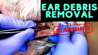 INSANE Ear Debris Debulking  CONTOUR DERMATOLOGY [upl. by Fawcett255]