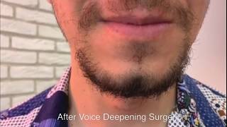 Voice DeepeningMasculinization Surgery [upl. by Ariamo252]