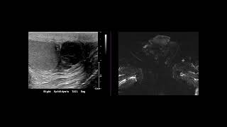 Epididymitis with abscess [upl. by Krik]