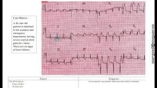 شرح ECG دمحمود سويلم [upl. by Arrak]