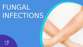 Fungal Infections  Causes Prevention and Cure [upl. by Basilio]