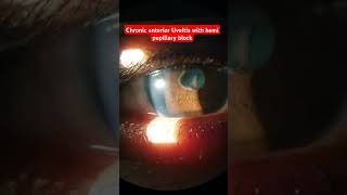 Chronic anterior Uveitis with hemi pupillary block neetpg ophthalmology shorts uveitis eyes [upl. by Ameen]