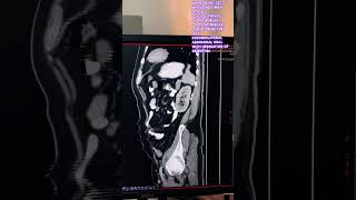 CHOLELITHIASIS HEPATOMEGALY PROSTATOMEGALY LEFT POSTEROLATERAL ABDOMINAL WALL HERNIATION OMENTUM [upl. by Tesil]