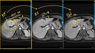 Focal Nodular Hyperplasia Typical Appearance on Liver MRI [upl. by Shig]