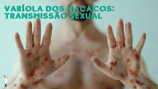 🙈“Varíola dos Macacos Transmissão Sexual em Foco”🙉 [upl. by Alleinad10]