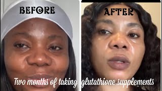 My journey with glutathione Supplements￼ [upl. by Ahsie]