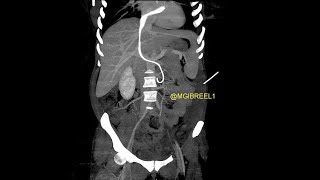 Intracardiac migration of ureteral doubleJ stent till the PV level [upl. by Massarelli]