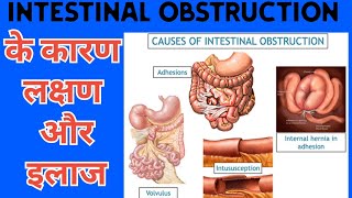 Intestinal Obstruction अंतो में रुकावत क्यू होती हैemergency doctor hospitaldoctor obesity [upl. by Nnoj]