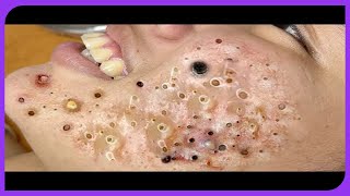 Satisfying Blackhead Removal Popping Pimples and Blackheads on Skin  2024 [upl. by Zedecrem750]