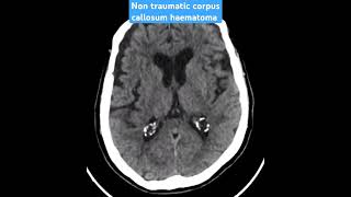 CT scan case 71 non traumatic corpus callosum haematoma ctscan radiology radiologist mri [upl. by Nulubez]