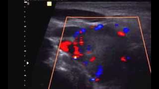 Carotid Body Tumor chemodectoma paraganglioma  Doppler [upl. by Leahcimnhoj108]