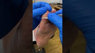 Journey to smooth feet begins here Follow an Aussie podiatrists guide to callus removal [upl. by Drofdarb]