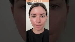 Korean Skincare Review Seoul Ceuticals Vitamin C Serum for Acne Solution  Before amp After [upl. by Aremaj]