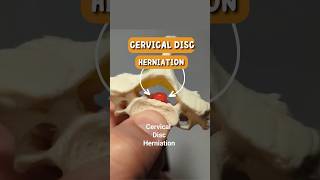 Cervical Disc Herniation Rupture of Cervical Disc Model [upl. by Salsbury]