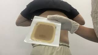 Hydrocolloid Wound Dressing [upl. by Koo142]