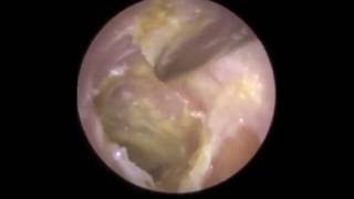 Infection of Eardrum visible after Hard Ear Wax Removal  Mr Neel Raithatha The Hear Clinic [upl. by Pierro]