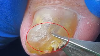 Mss Toenail  Satifying video toenial clean  Dirty Toenail Removal [upl. by Pas527]