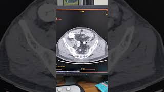 What Is A Hydrocelectscan mbbs mri doctor [upl. by Pendergast]