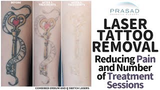 How Tattoos Removal can be Done with Less Pain and Fewer Treatment Sessions [upl. by Hendon]