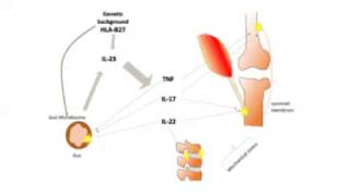 SPONDYLOARTHRITIS part1 [upl. by Oicnecserc]