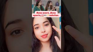 Acne scars acnescars acne acneremoval acnetreatment shorts beautytips skincare pimple short [upl. by Viviane]