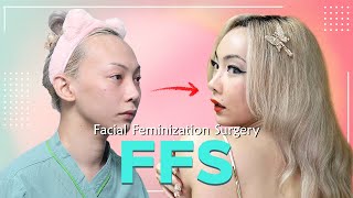 FFS review from surgery to 60 days [upl. by Eirahs]