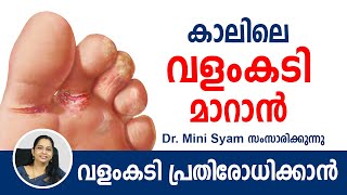 കാലിലെ വളംകടി മാറാൻ  Malayalam Health Tips [upl. by Ehtylb]