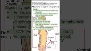 Abdominal compartment syndrome [upl. by Senga]