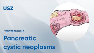 Pancreatic cystic neoplasms – Please participate in our 3minute survey below [upl. by Ykvir]