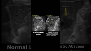 Hepatic Abscess On Ultrasound  Liver Normal Vs Abnormal USG  Abdominal Sonography shorts [upl. by Obelia]