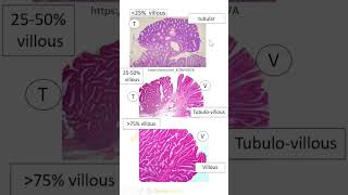 Lesions in Pathology Polyps Dr GSS SRM MCH RC httpsyoutubeKJT8vYOD7A [upl. by Daphie381]