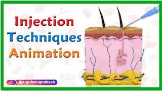 Injection Techniques Animation  Intradermal Intramuscular Subcutaneous and Z track [upl. by Papp]