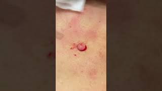 QUICK BACK CYST [upl. by Uon]