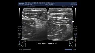 The scanning and localization of Acute Appendicitis [upl. by Prowel163]