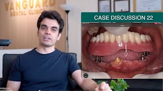 Denture on Implants  Case Discussion 22 [upl. by Anen]