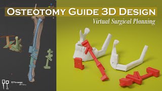 Osteotomy Guide 3D Design  Mandibular reconstruction [upl. by Innos]