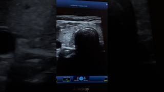 Hashimoto Tyroiditis Ultrasound  Hypothyroidism Sonography  ARDMS [upl. by Valma89]